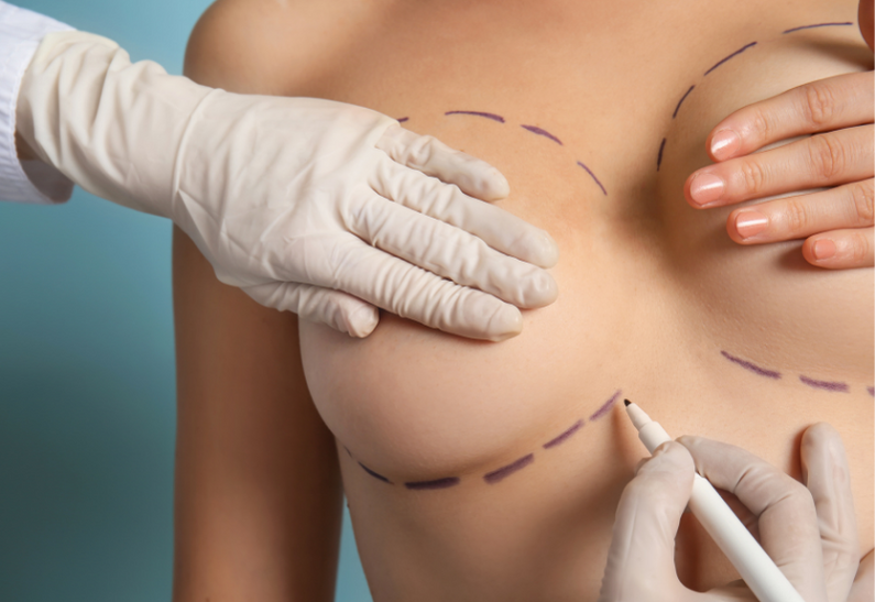 Breast augmentation