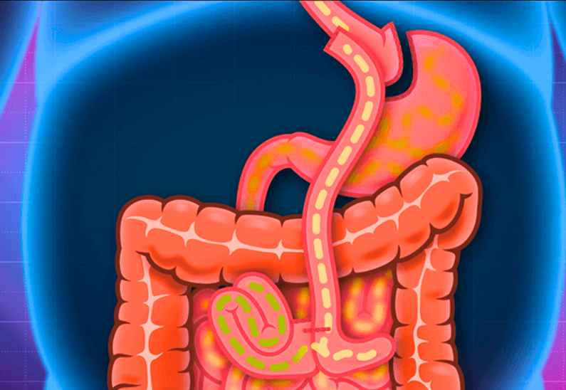 gastric bypass surgery